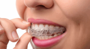 Best Teeth Straightening For Adults