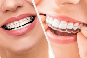 Clear Braces