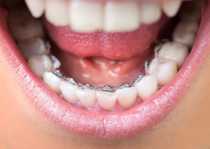 Lingual Braces