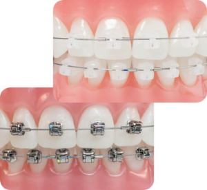 Lingual vs. Traditional Braces