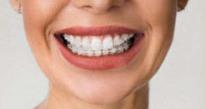 clear and metal braces