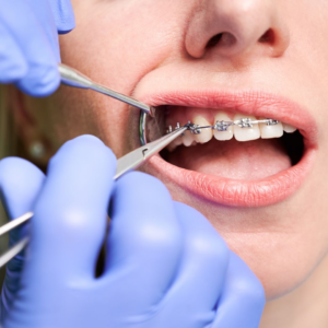 Traditional Braces