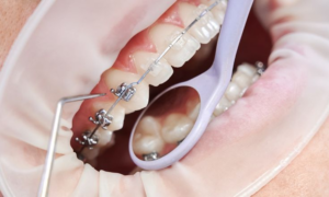 Adult Braces